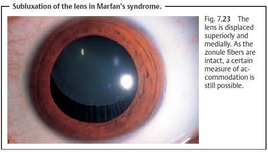 Marfan Syndrome: Causes, Symptoms, and Management