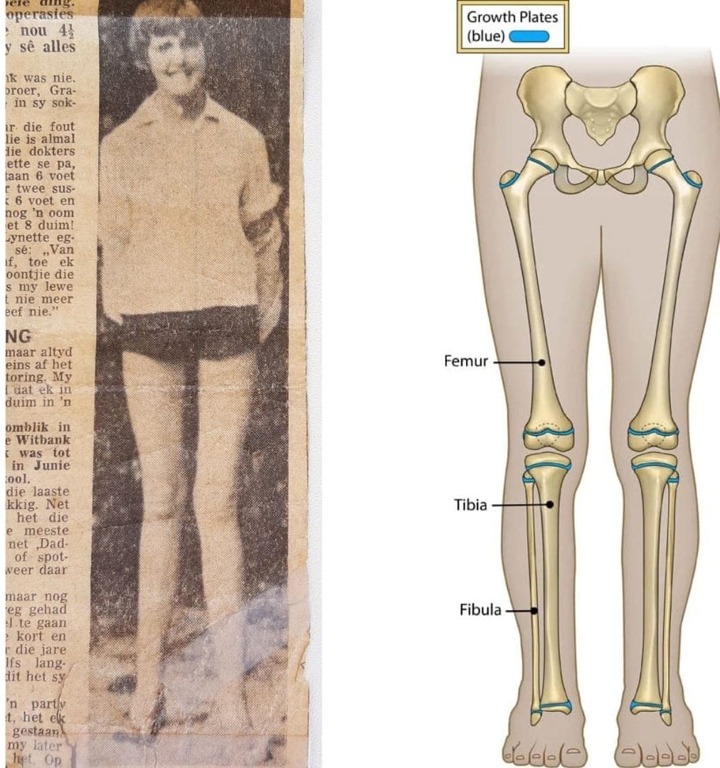 Marfan Syndrome and Me: I had Height Reduction Surgery