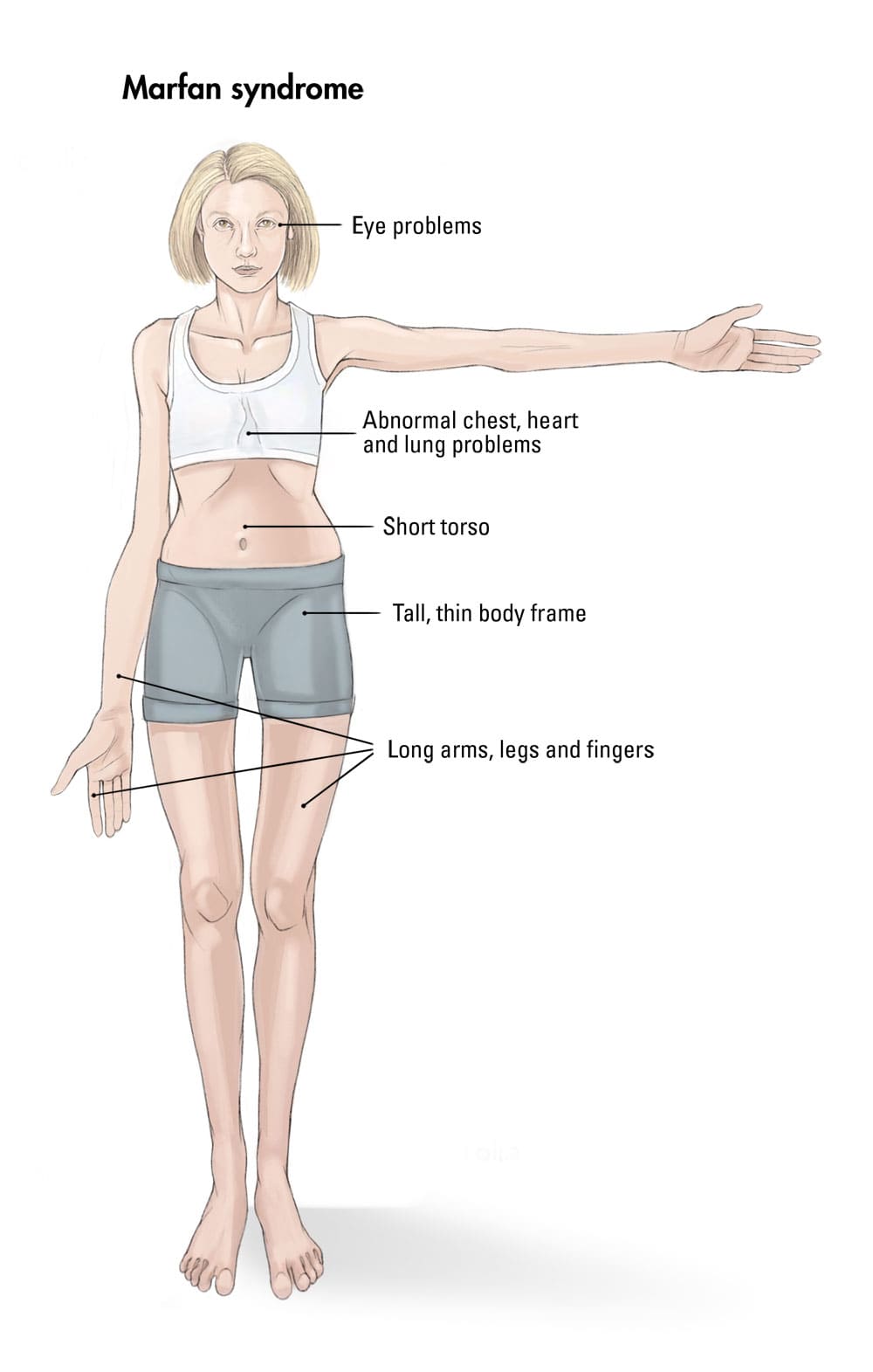 Marfan Syndrome: Causes, Symptoms, and Management